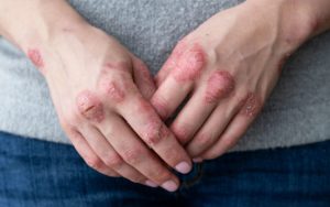 psoriasis