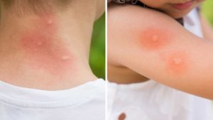 Piqûres de moustique