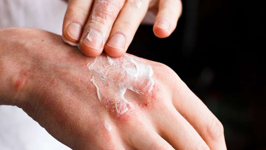 Eczéma des mains. © Ольга Тернавская, Fotolia
