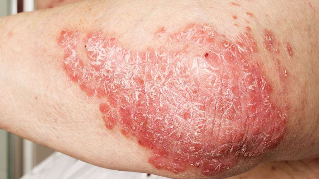 Eczéma du bras. © Milan Lipowski, Fotolia 