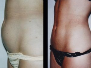 Lipoaspiration