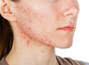 allergie au sucre